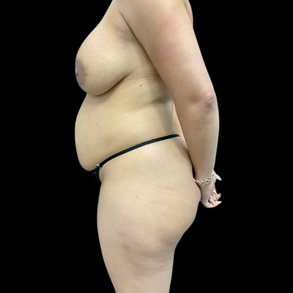 Tummy Tuck Case 1 - Before