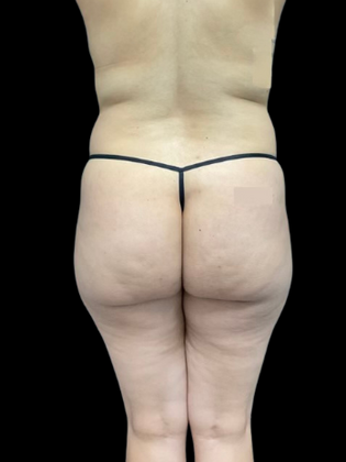 Brazilian Butt Lift BBL 5 - Before