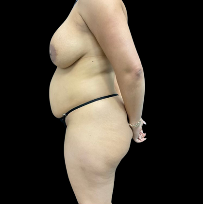 Brazilian Butt Lift: Case 4 - Before