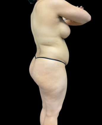 Brazilian Butt Lift Case 4 - Before