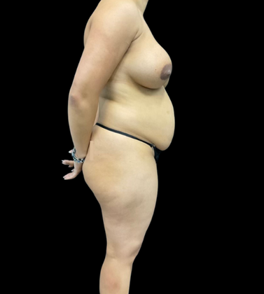 Brazilian Butt Lift: Case 4 - Before