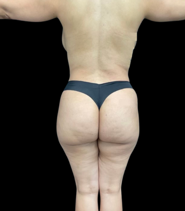 Brazilian Butt Lift: Case 4 - After