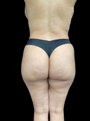 Brazilian Butt Lift BBL 5 - After