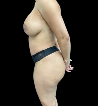 Brazilian Butt Lift: Case 4 - After