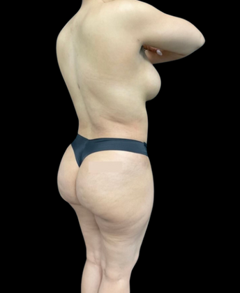 Brazilian Butt Lift Case 4 - After