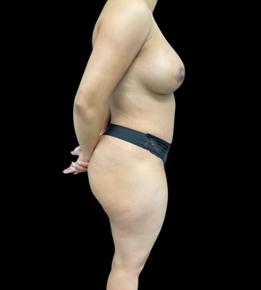 Brazilian Butt Lift: Case 4 - After