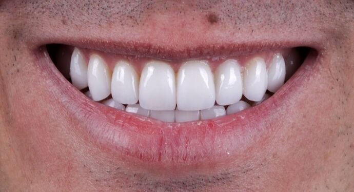 Smile Makeover & Veneers Tristen