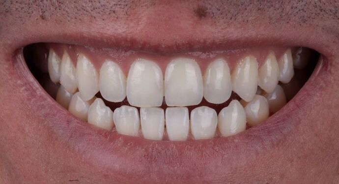 Smile Makeover & Veneers: Tristen - Before
