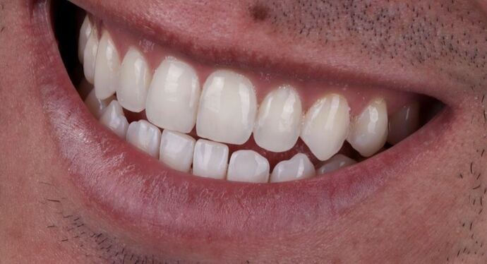 Smile Makeover & Veneers: Tristen - Before