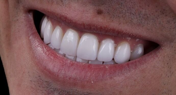 Smile Makeover & Veneers: Tristen - After