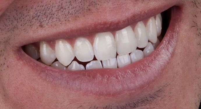 Smile Makeover & Veneers: Tristen - Before