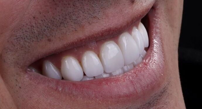 Smile Makeover & Veneers: Tristen - After