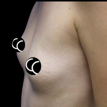 Breast Augmentation Case 4 - Before