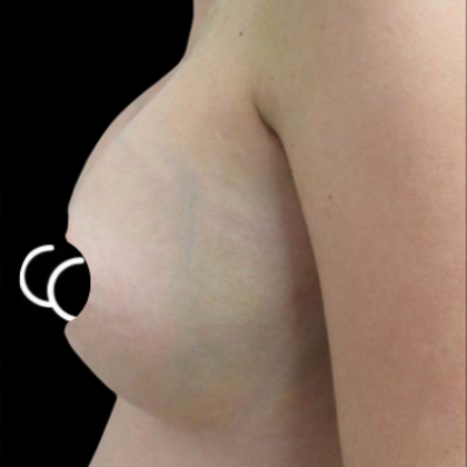 Breast Augmentation Case 4 - After