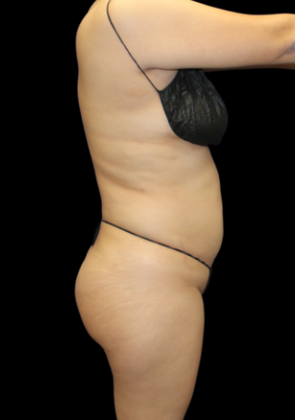 Liposuction: Case 5 - Before
