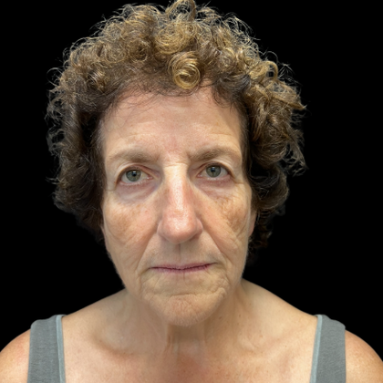 Face & Neck Lifts Case 2 - Before