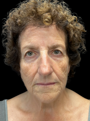 Face & Neck Lifts Facelift 1 - Before