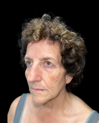 Face & Neck Lifts: Case 2 - Before