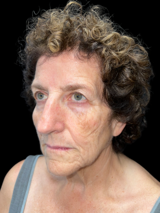 Face & Neck Lifts: Facelift 1 - Before