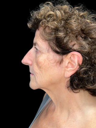 Face & Neck Lifts: Facelift 1 - Before