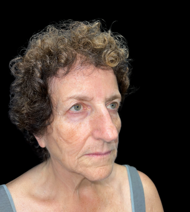 Face & Neck Lifts: Case 2 - Before