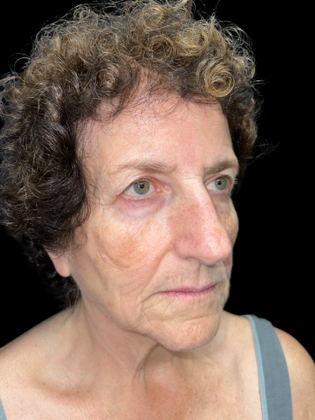 Face & Neck Lifts: Facelift 1 - Before