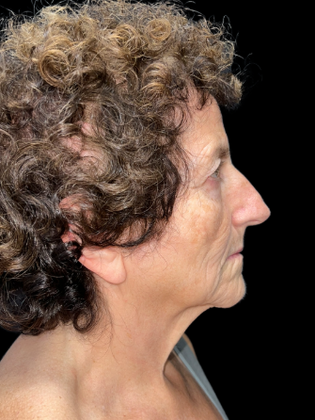 Face & Neck Lifts: Facelift 1 - Before