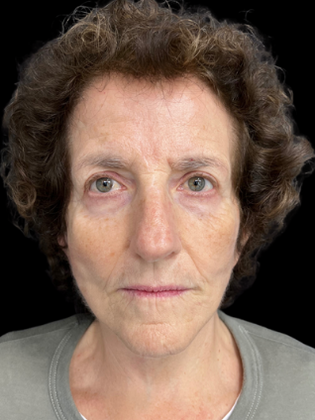 Face & Neck Lifts Facelift 1 - After