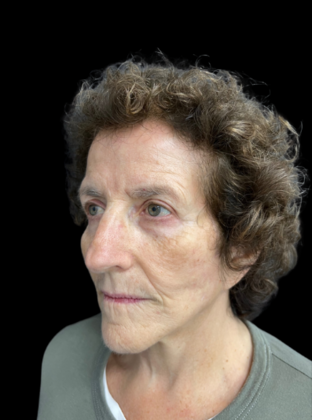 Face & Neck Lifts: Case 2 - After