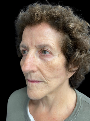 Face & Neck Lifts: Facelift 1 - After
