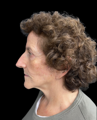 Face & Neck Lifts: Case 2 - After