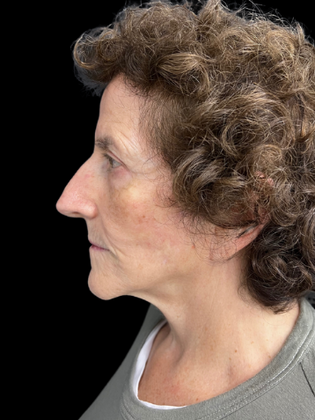Face & Neck Lifts: Facelift 1 - After