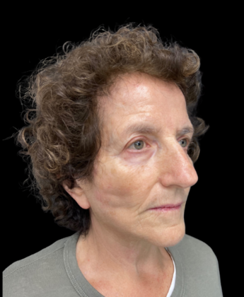 Face & Neck Lifts: Case 2 - After