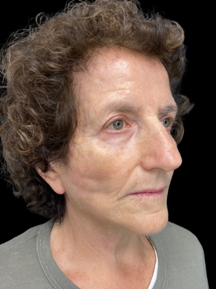 Face & Neck Lifts: Facelift 1 - After
