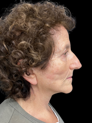 Face & Neck Lifts: Facelift 1 - After