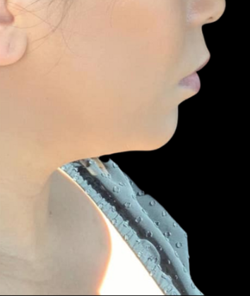 Chin Liposuction Case 1 - Before