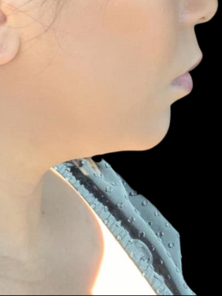 Chin Liposuction Chin Liposuction 1 - Before