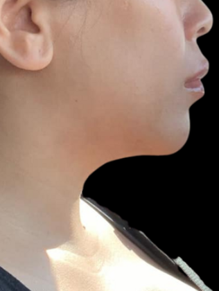 Chin Liposuction Chin Liposuction 1 - After