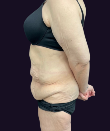 Lower Body Lift: Case 1 - Before