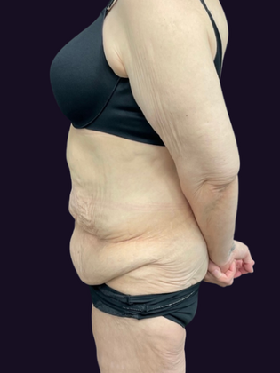 Lower Body Lift: Lower Body Lift 1 - Before