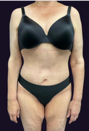 Lower Body Lift Case 1 - After