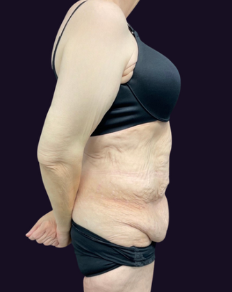 Lower Body Lift: Case 1 - Before