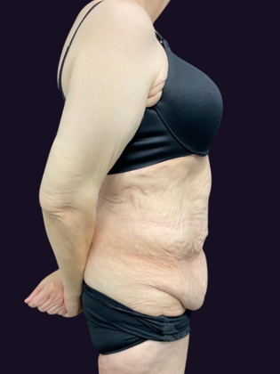 Lower Body Lift: Lower Body Lift 1 - Before
