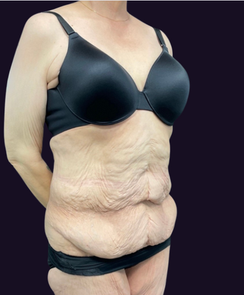 Lower Body Lift: Case 1 - Before