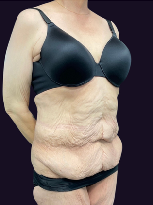 Lower Body Lift: Lower Body Lift 1 - Before