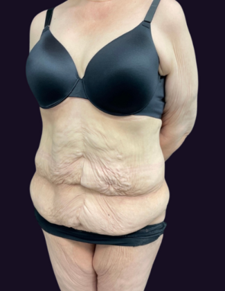 Lower Body Lift: Case 1 - Before