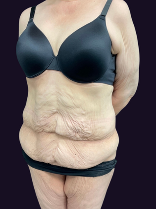 Lower Body Lift: Lower Body Lift 1 - Before