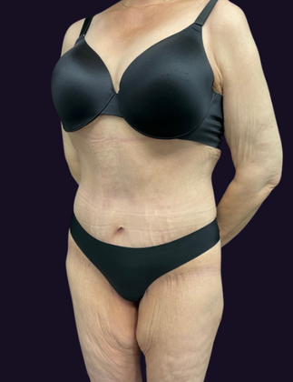 Lower Body Lift: Case 1 - After