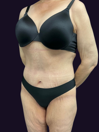 Lower Body Lift: Lower Body Lift 1 - After