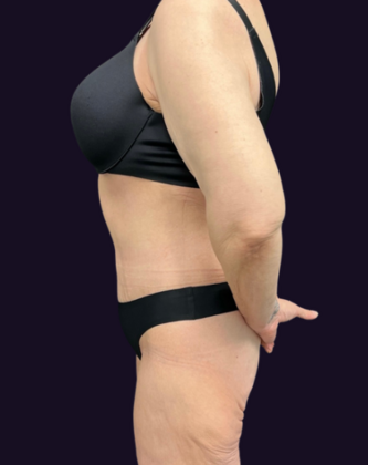 Lower Body Lift: Case 1 - After